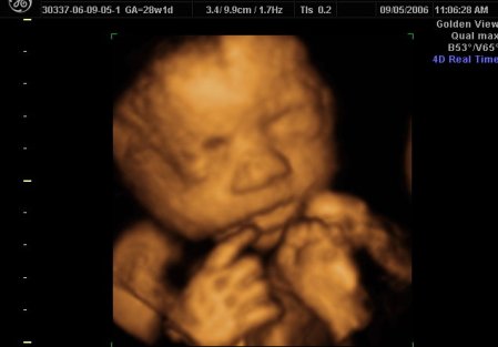 3d ultrasound pictures. 3d ultrasound Image taken at