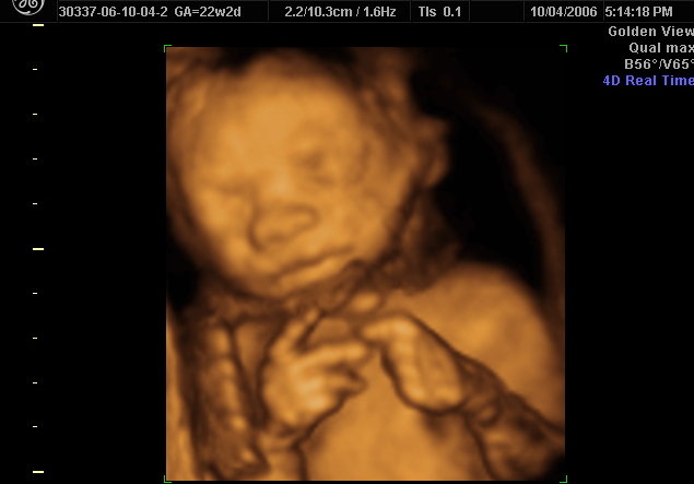 3d ultrasound pictures. 3d ultrasound 22 weeks 2 days